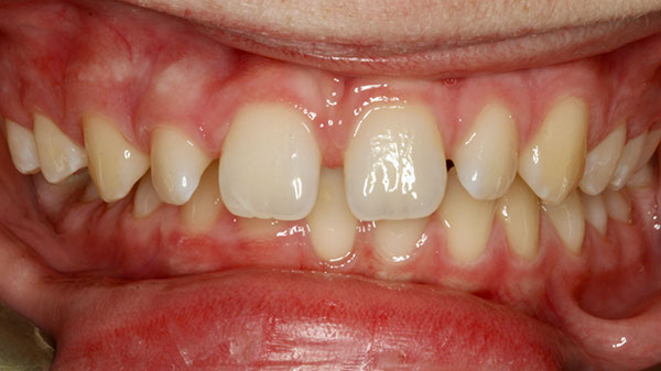 Before-Spaced-Teeth-Treatment